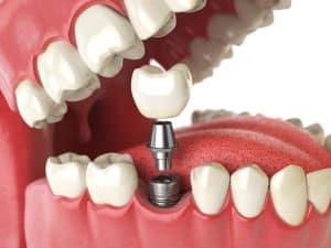 Mill Valley Dental Implants